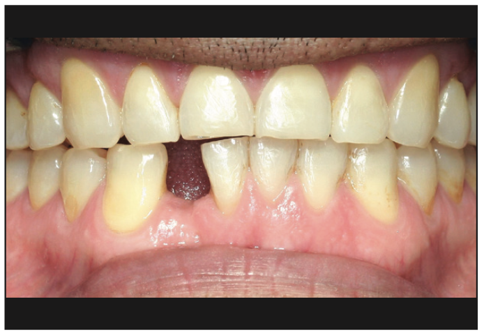 ceramic implants