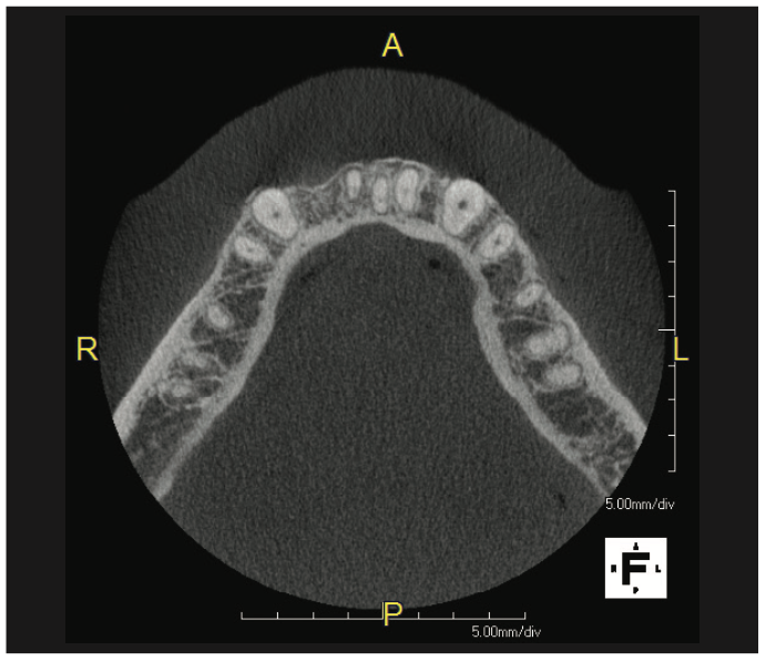 ceramic implants