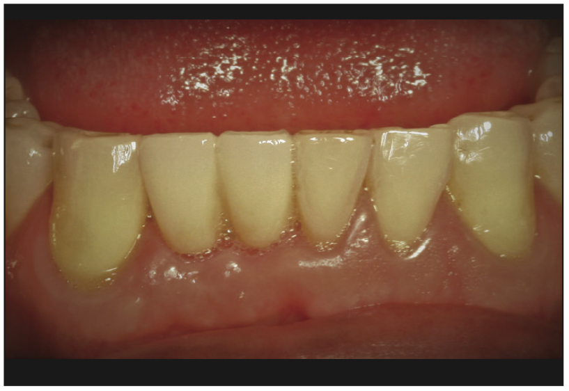 ceramic implants