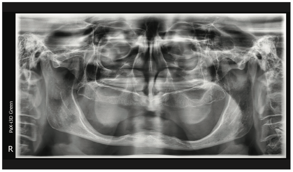 prosthetic reconstruction