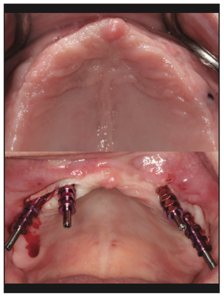 prosthetic reconstruction
