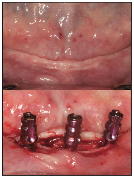 prosthetic reconstruction