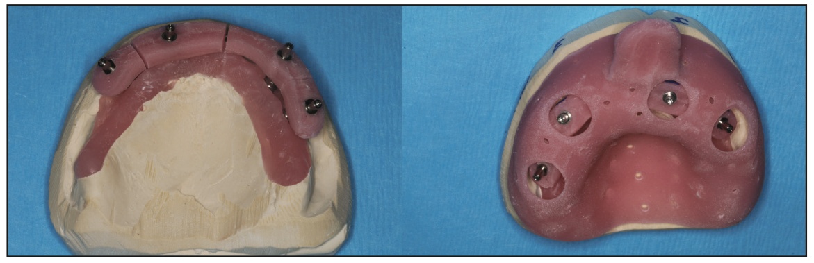 prosthetic reconstruction