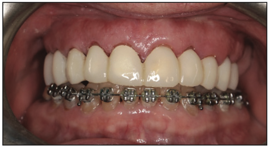 3D Printed Restorations