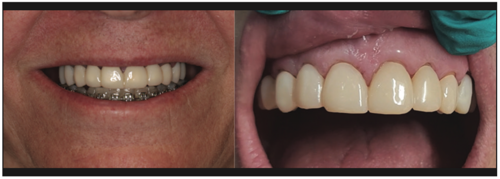 3D Printed Restorations