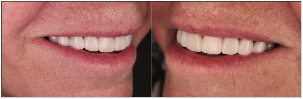 3D Printed Restorations