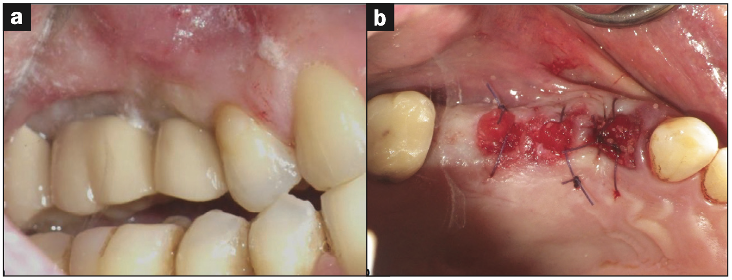 dentin grafting