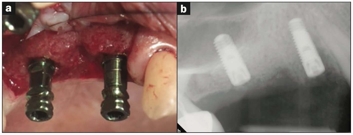 dentin grafting