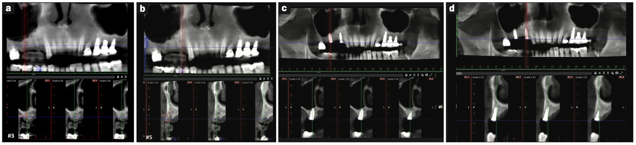 dentin grafting