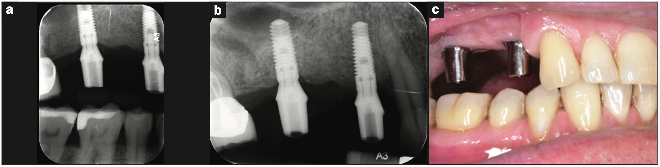 dentin grafting