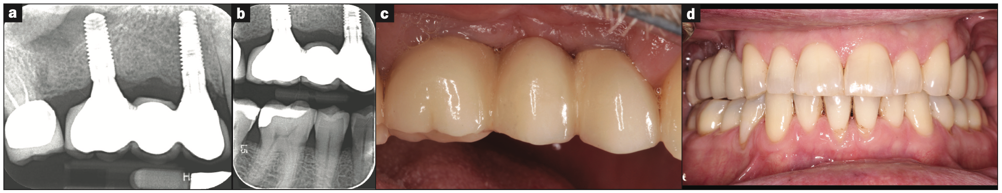 dentin grafting