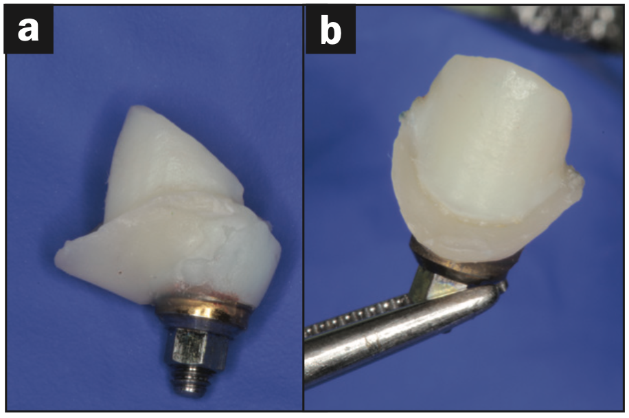 maxillary central incisor implant