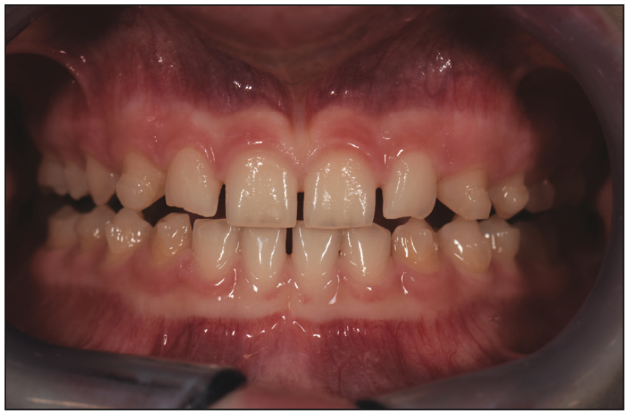 cosmetic veneers