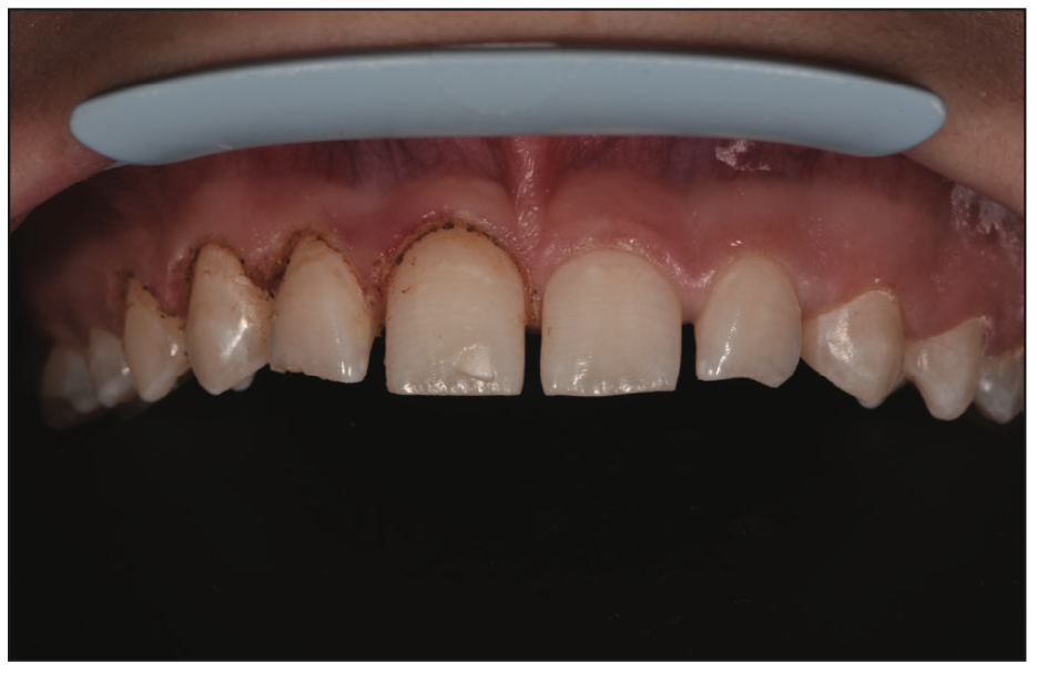 cosmetic veneers