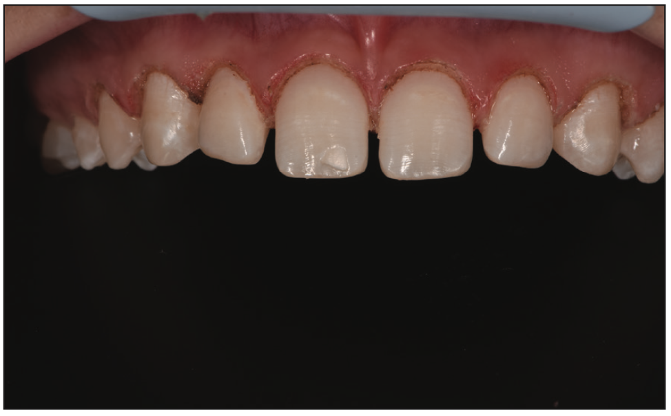cosmetic veneers