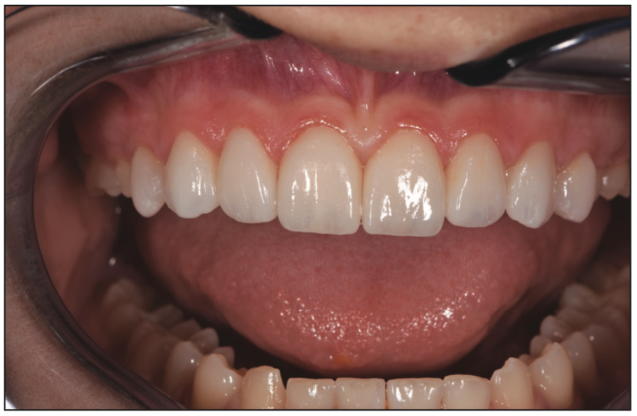 cosmetic veneers