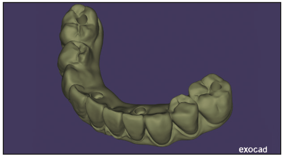 full-arch temporary restorations
