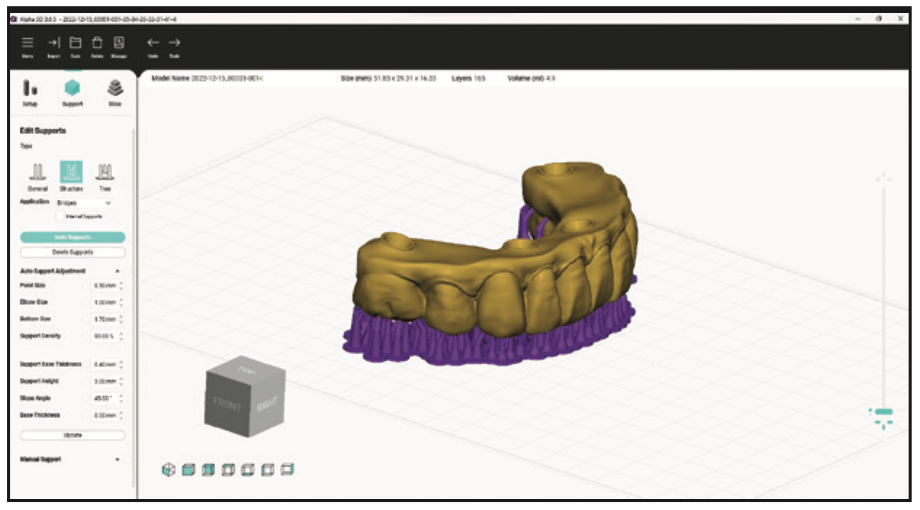 full-arch temporary restorations