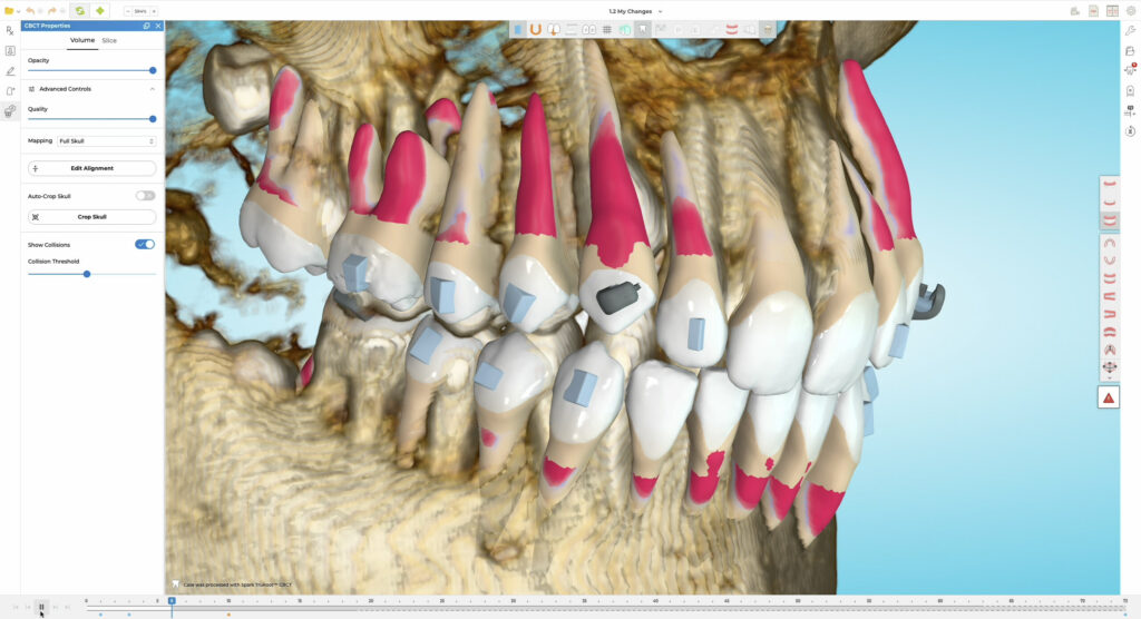spark clear aligners
