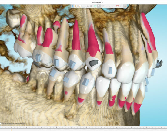spark clear aligners