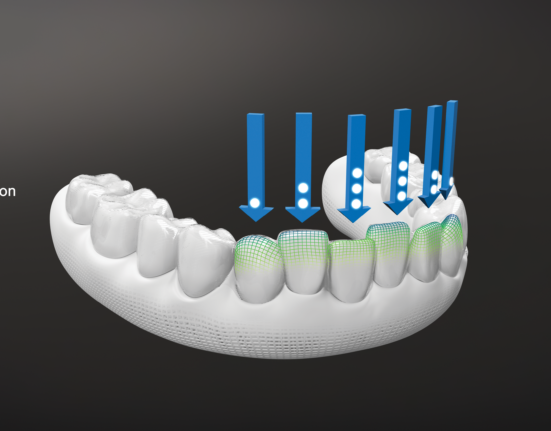 teeth aligner