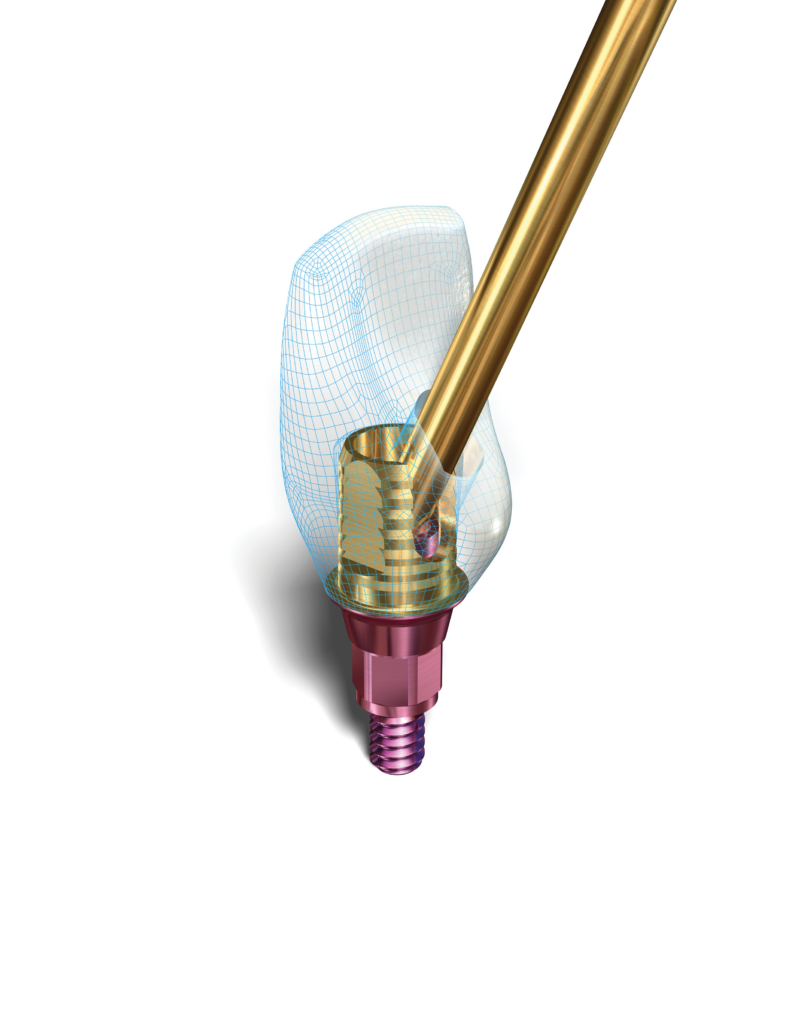 implant direct, abutment system