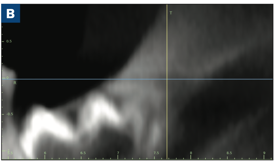 third molar