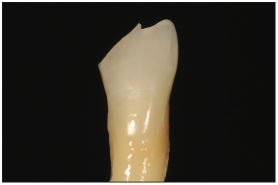 single-shade composites