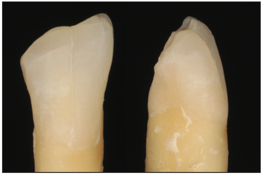 single-shade composites