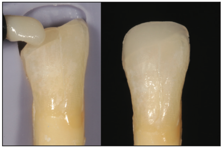 single-shade composites