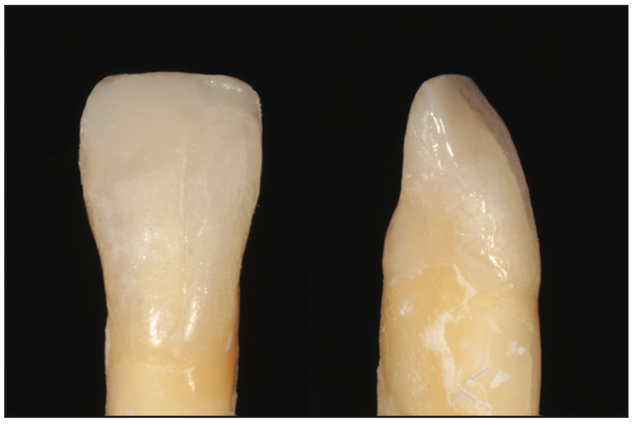 single-shade composites