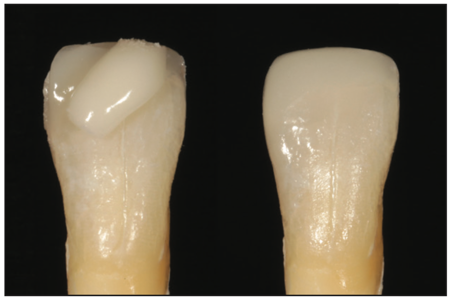 single-shade composites