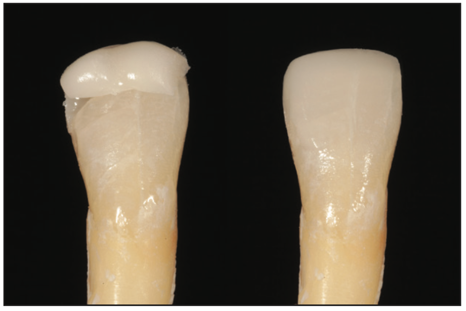 single-shade composites