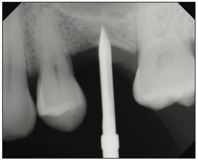 sinus augmentation