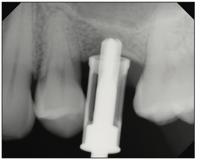 sinus augmentation