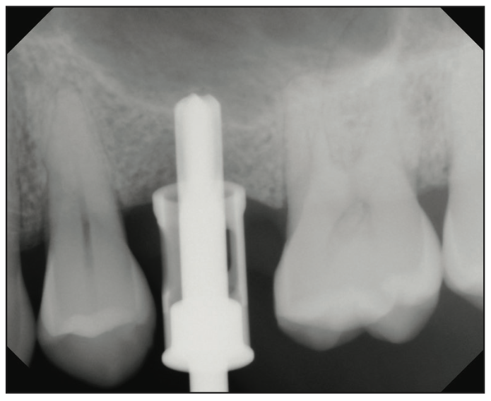 sinus augmentation