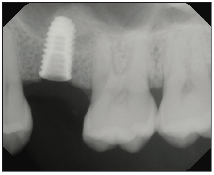 sinus augmentation