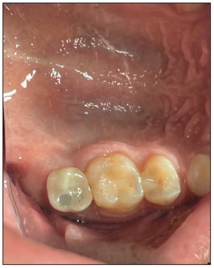 sinus augmentation