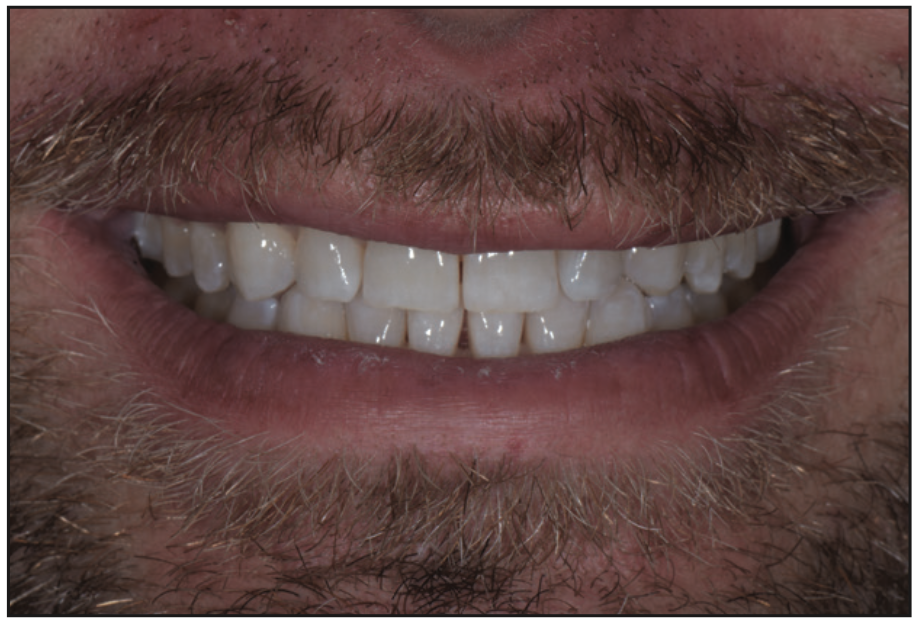 direct composite veneers
