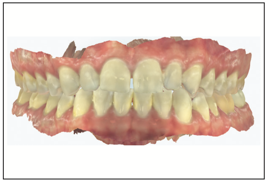 direct composite veneers