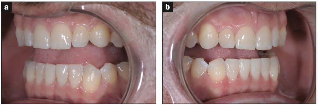 direct composite veneers