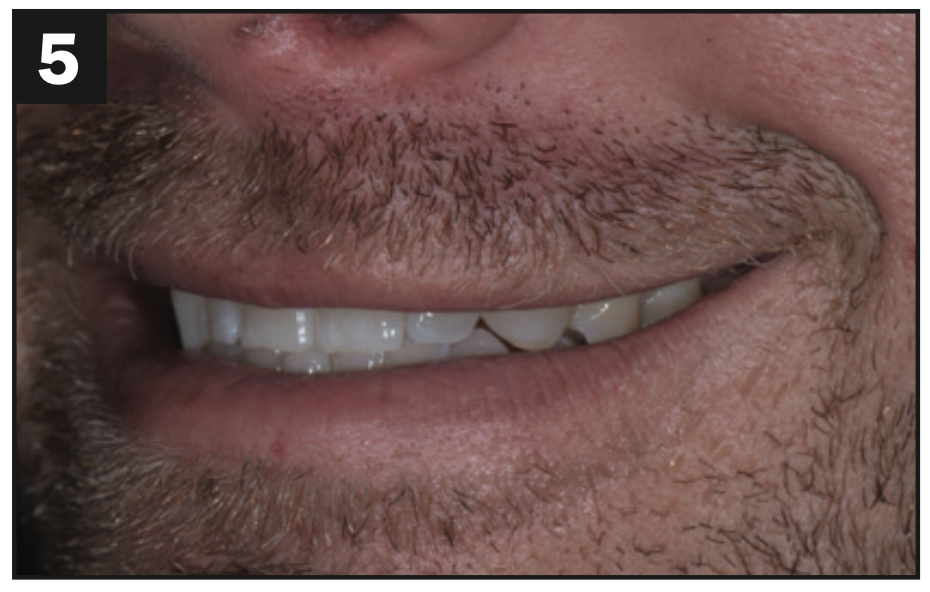 direct composite veneers