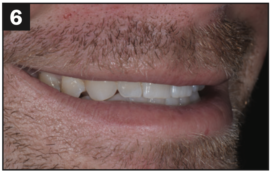 direct composite veneers