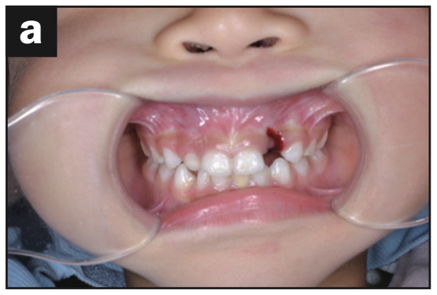 incisors