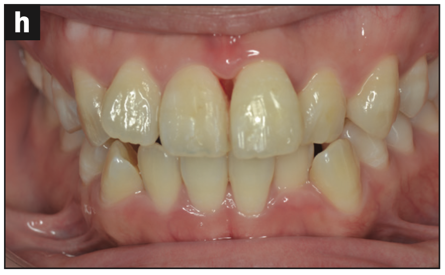 incisors