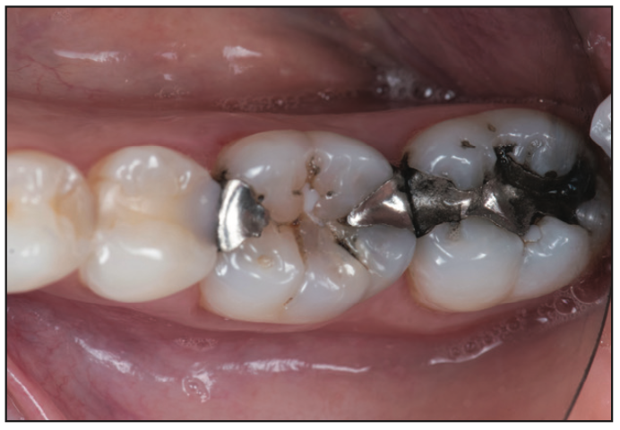 ceramic resin restoration