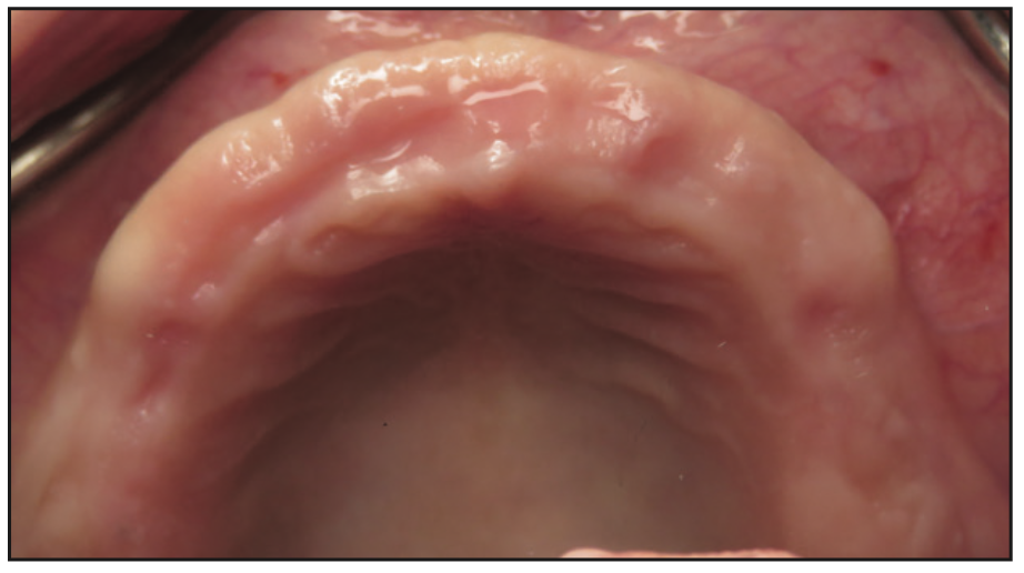 ceramic implants