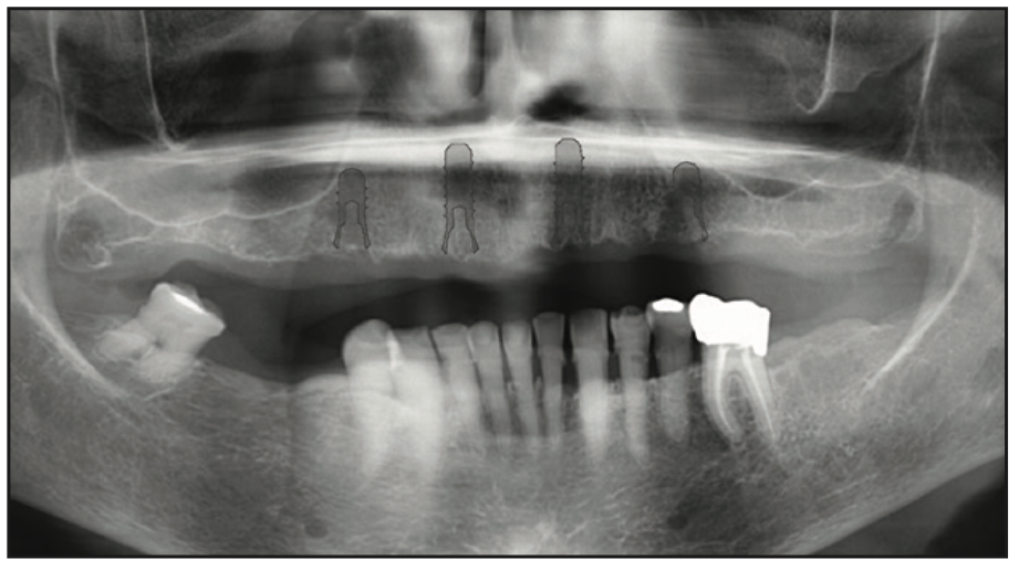 ceramic implants