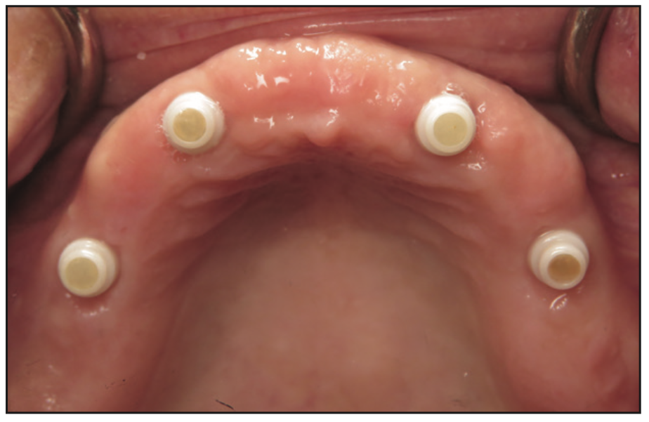 ceramic implants