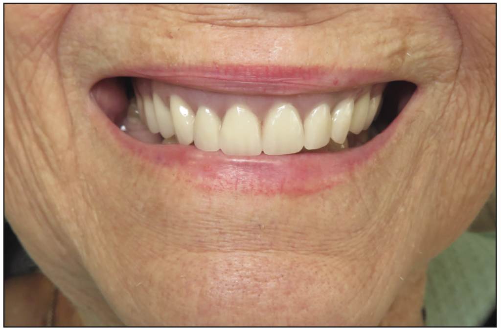 ceramic implants